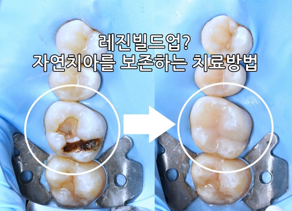 레진빌드업